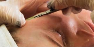 Dermaplaning