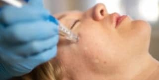 Microneedling