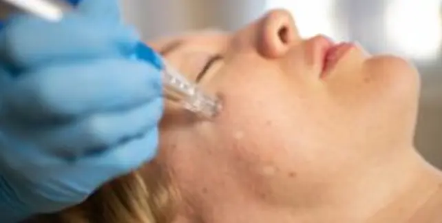 Microneedling
